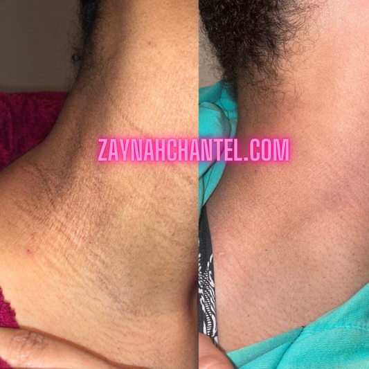 Treat Eczema without steroids